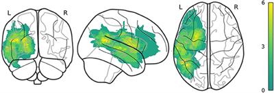 Predicting Early Post-stroke Aphasia Outcome From Initial Aphasia Severity